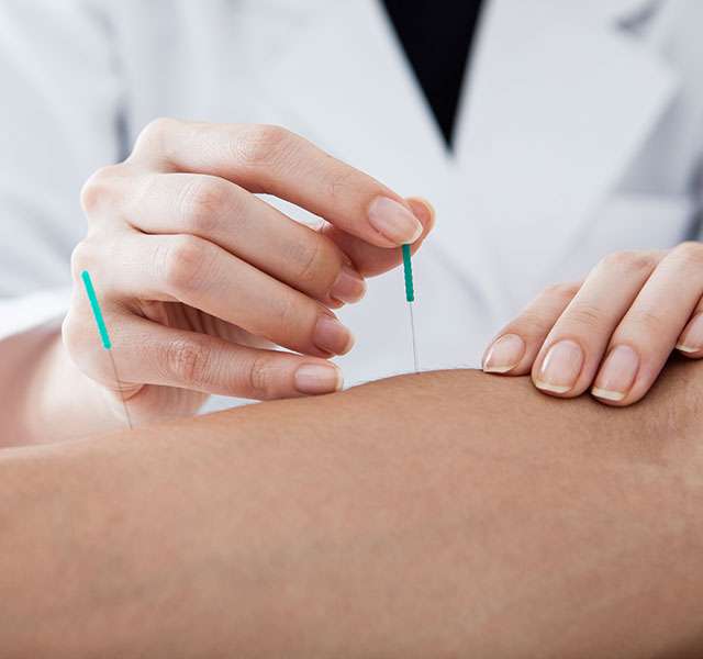 Needles of Relief | Is Acupuncture Good for You